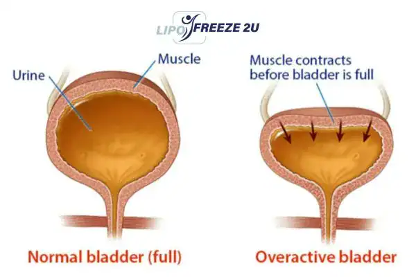 diagram of overactive bladder treatment Walsall