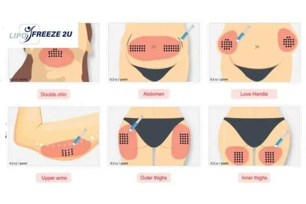 Benefits of Choosing Aqualyx for Fat Reduction Walsall