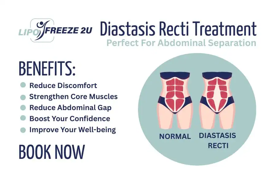 How Long Will It Take to See Improvements in Diastasis Recti Walsall