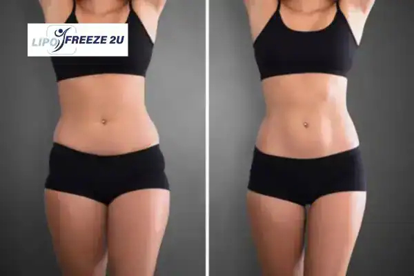 How Can LIPO FREEZE 2U Support Your Post-Pregnancy Body Recovery Walsall?