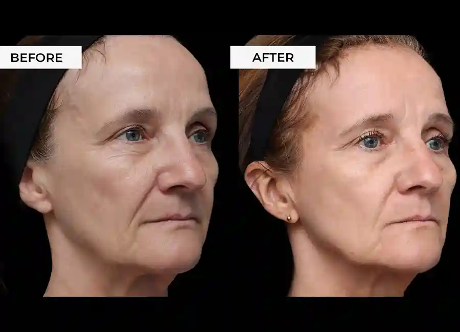 How Many RF Microneedling Sessions Will You Need to See a Difference Walsall?