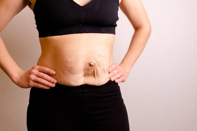 Is Surgery Really the Only Way to Repair Diastasis Recti Walsall?