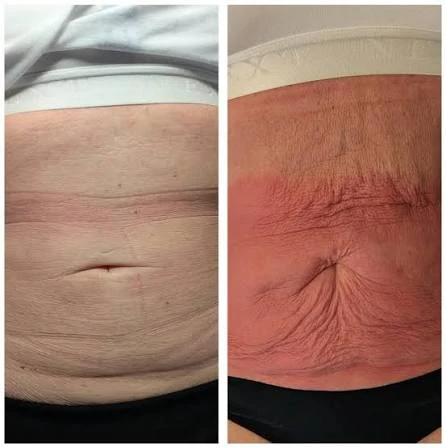 How Does RF Microneedling Improve Crepey, Thin and Uneven Skin Texture Walsall?