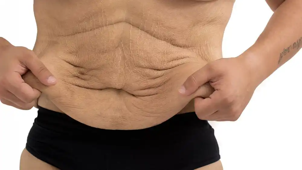 Why Does Weight Loss Medication Leave Some People With Loose or Sagging Skin Walsall?